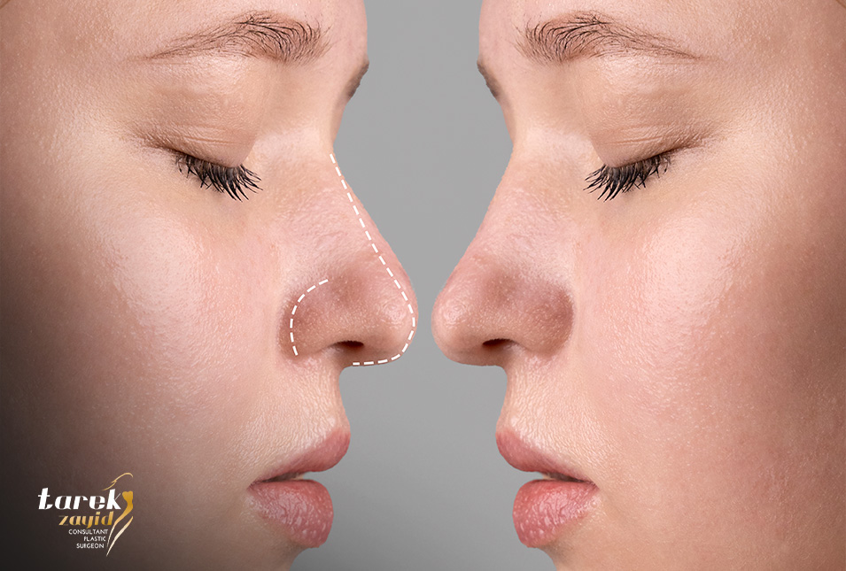 Non-Surgical-Rhinoplasty-in-Egypt