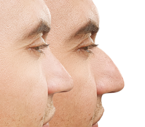 عمليات تجميل الأنف قبل وبعد للرجال