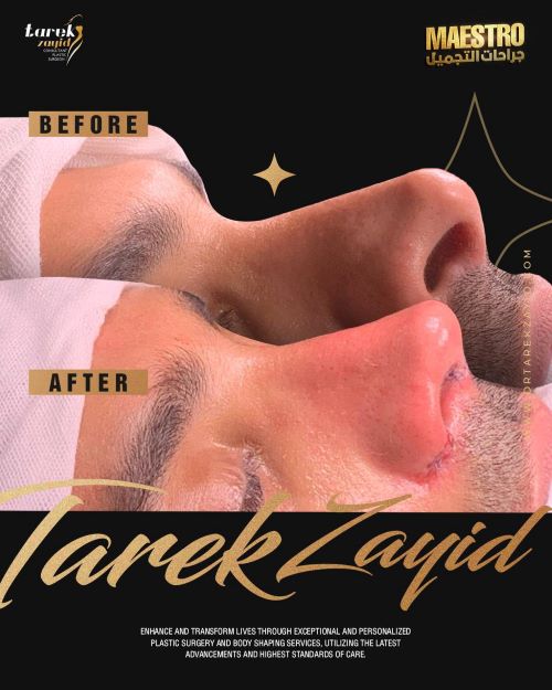 افضل دكتور تجميل انف في مصر 2026