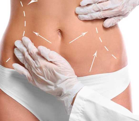 Tummy Tuck