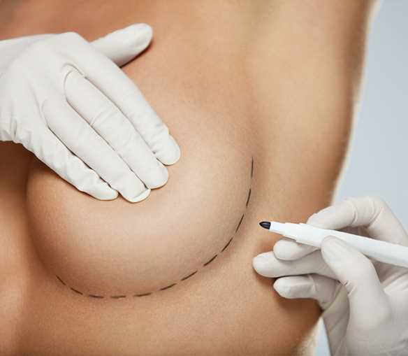 Breast augmentation