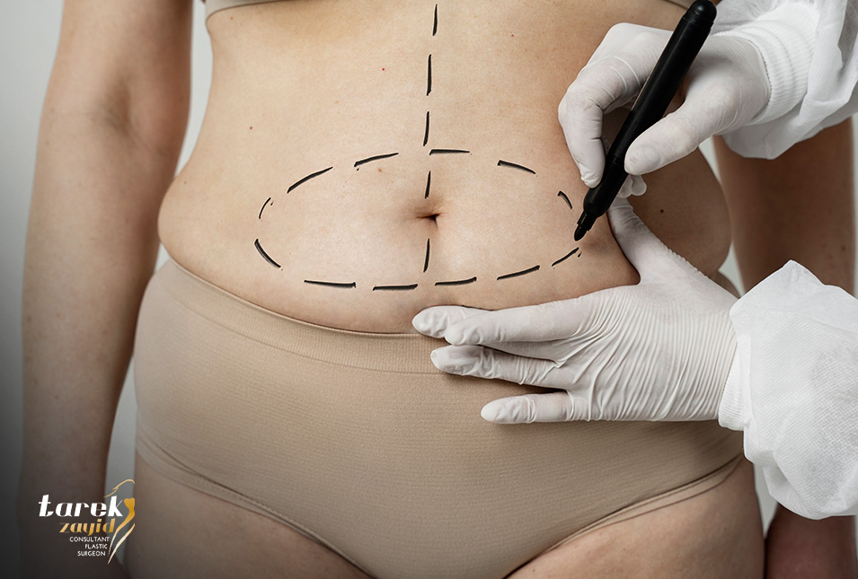 Tummy Tuck