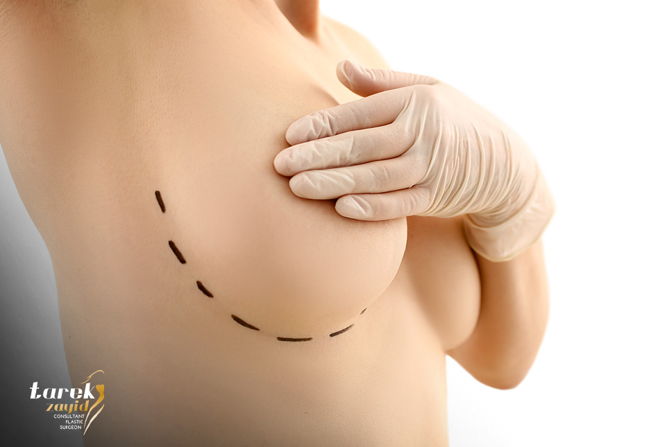 Breast lift
