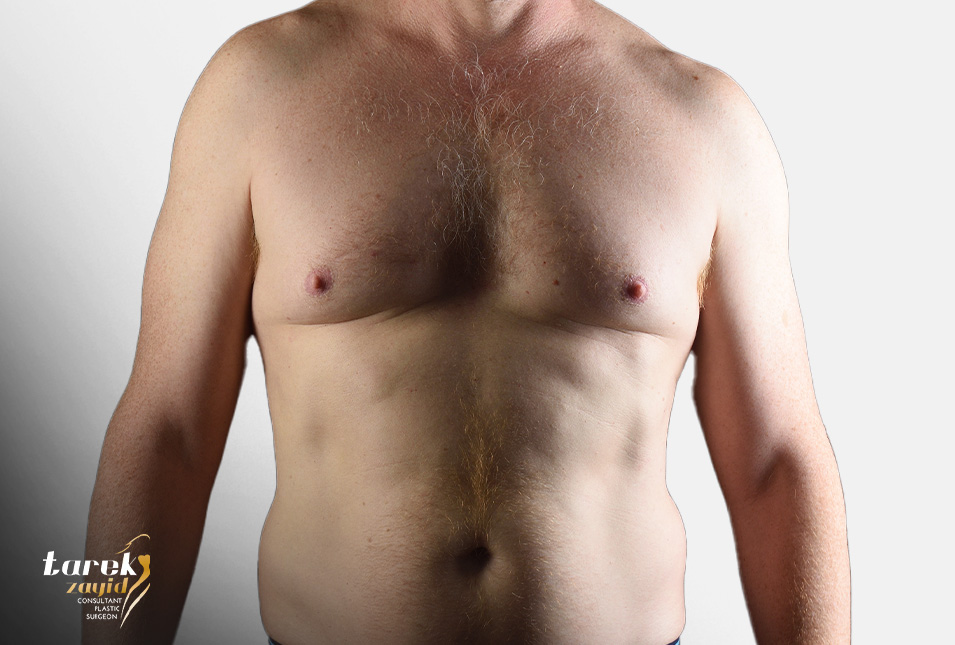 gynecomastia