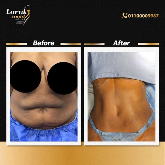 Immediate-Results-After-Tummy-Tuck-Procedure