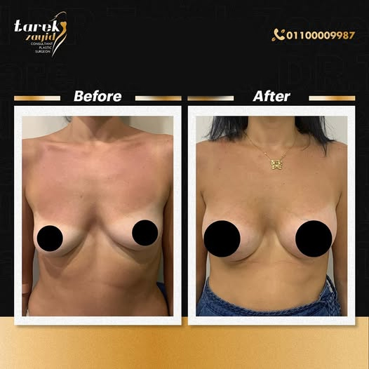 More-Femininity-After-Breast-Augmentation