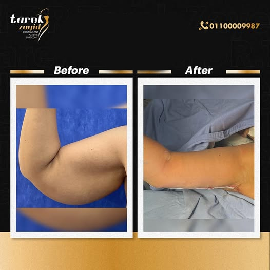 The-Difference-is-Obvious-After-an-Arm-Lift-Procedure
