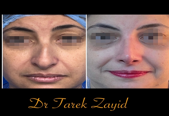  بعد جراحة تجميل الأنف