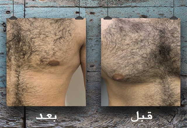 عملية علاج التثدى عند الرجال قبل و بعد  