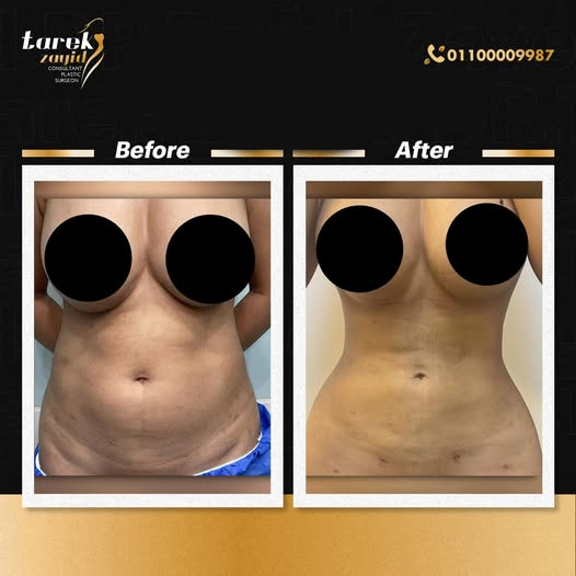 Your-Body-is-Toned-After-Liposuction