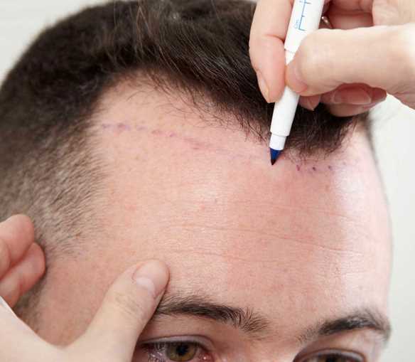 Hair Transplant