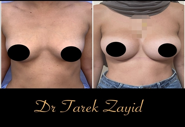 عملية تكبير الثدي قبل و بعد  